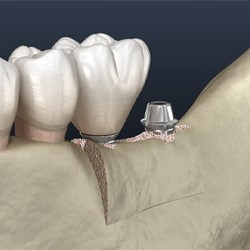 Illustration of ridge expansion for dental implants in Coppell, TX