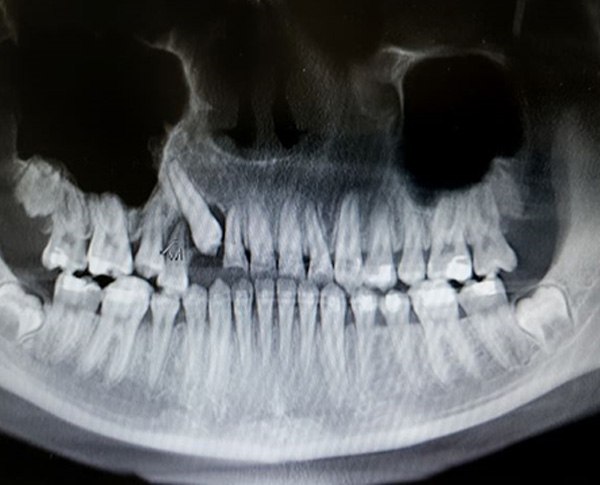 X-ray showing crooked, impacted tooth