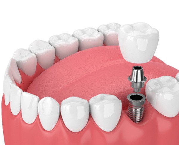 illustration representing dental implant post-op instructions in Coppell