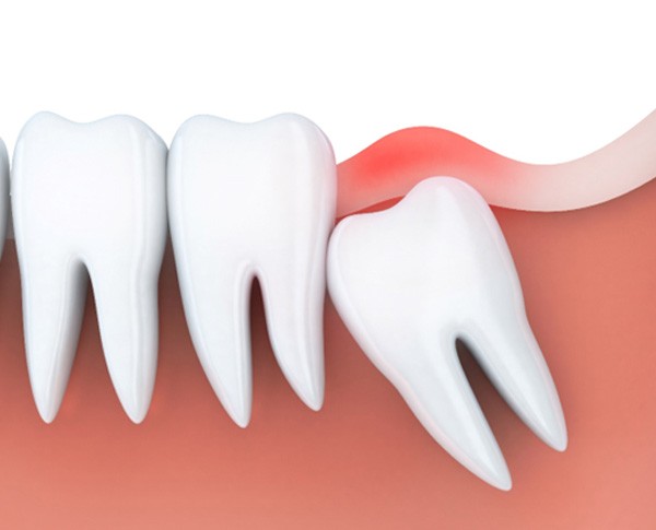 an illustration of an impacted wisdom tooth