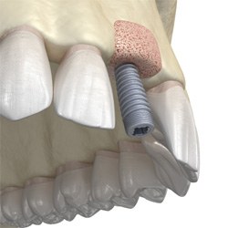 Illustration of bone graft for dental implants in Coppell, TX