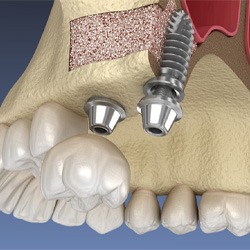Illustration of sinus lift for dental implants in Coppell, TX