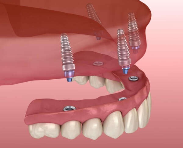 Animated smile during all on four dental implants placement