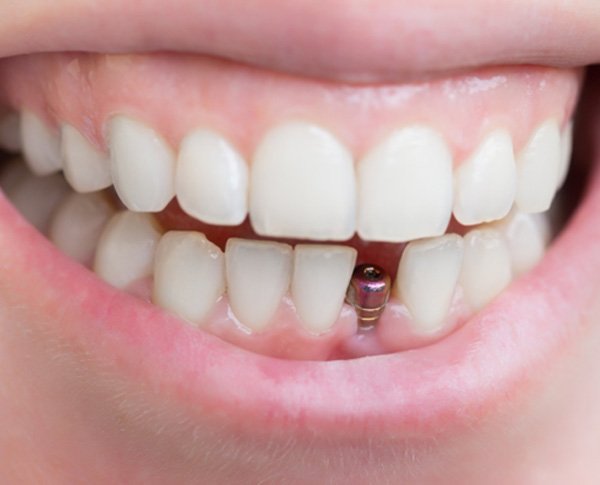 : a person with a dental implant for a front tooth