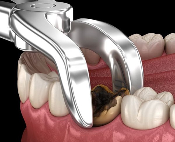 Illustration of forceps removing badly damaged tooth