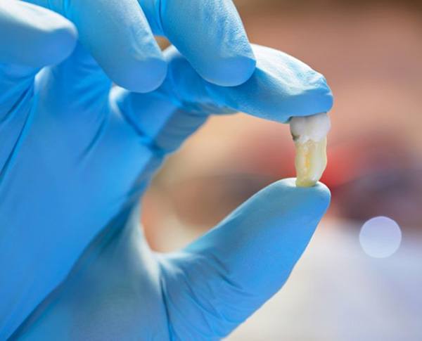 Close-up of gloved hand holding extracted tooth