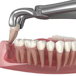 Illustration of forceps removing wisdom tooth