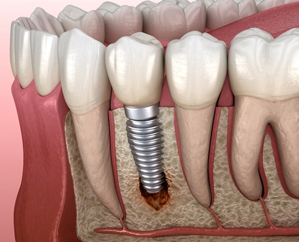 Failed dental implant in Coppell