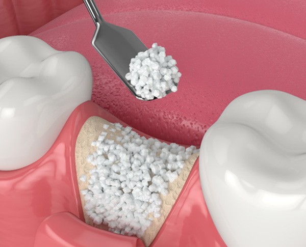 Digital illustration of bone augmentation