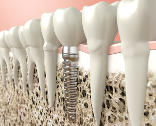 Digital illustration of dental implant