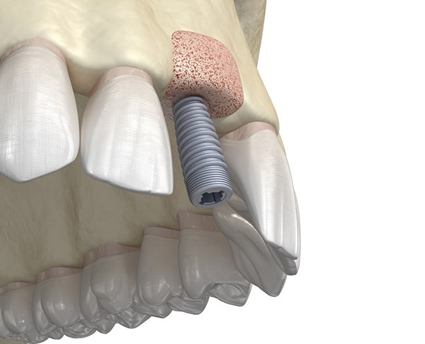 Dental implant being inserted at site of bone graft