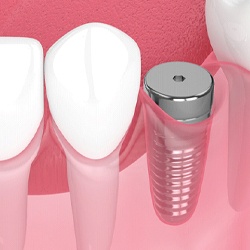 Close-up of model of dental implant in Coppell, TX with abutment