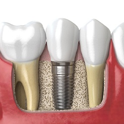 Illustration of dental implant in Coppell, TX with crown attached