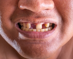 Smile with multiple missing teeth