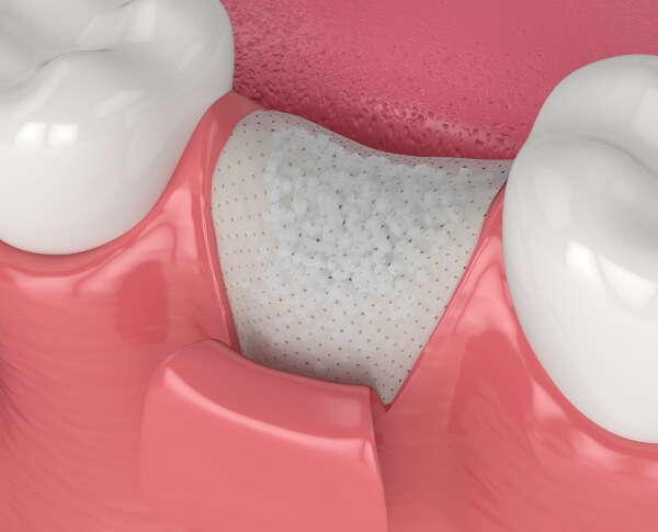 Animated smile with bone grafting