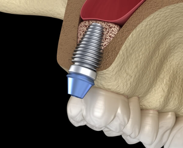Animated smile with dental implant placed after sinus lift