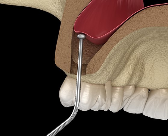 Illustration of a sinus lift in Coppell, TX