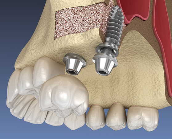 Dental implants placed after sinus lift in Coppell, TX
