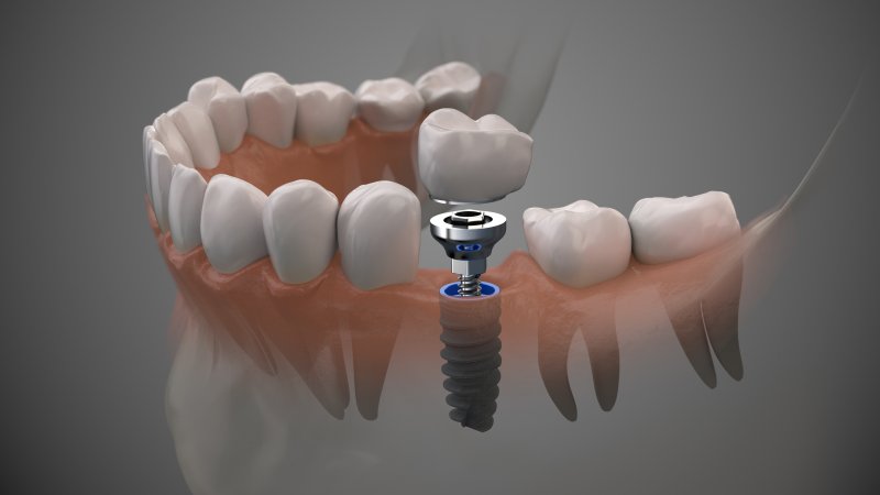 illustration of dental implants in Coppell