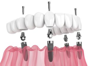 a digital replica of all-on-4 dental-implants