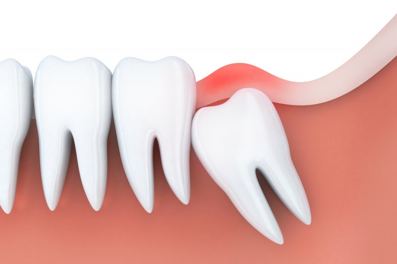 diagram of a wisdom tooth