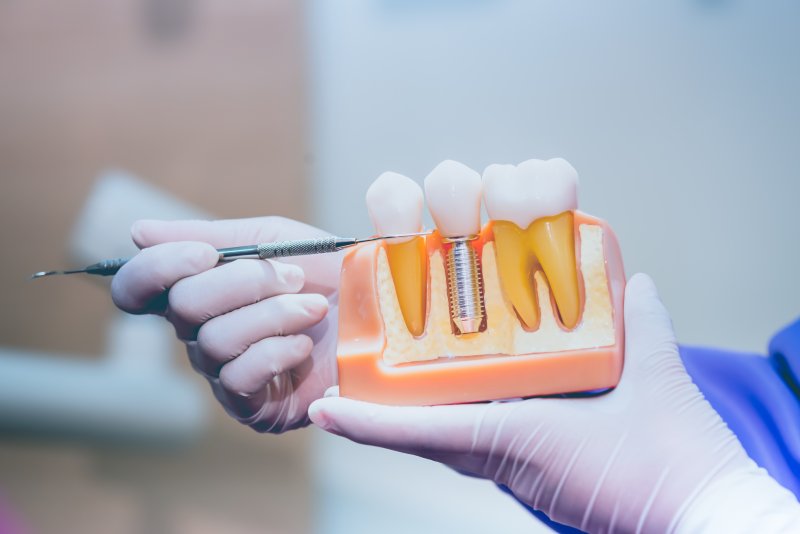 a dentist presenting a model of a dental implant