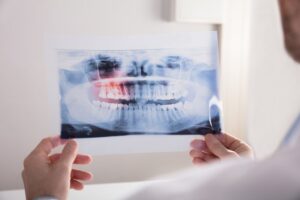 Dentist holds up X-ray of wisdom teeth.
