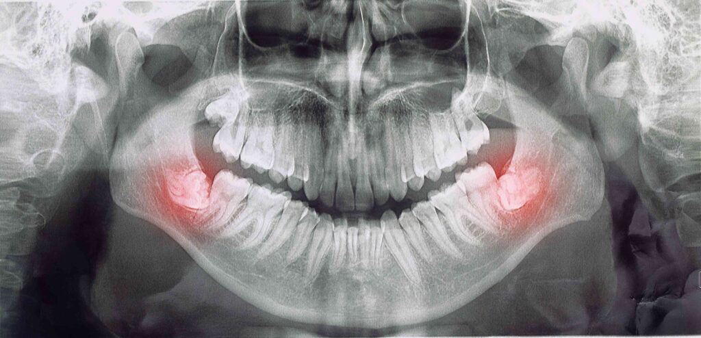 X-ray of wisdom teeth